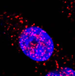 Proximity ligation assay shows the interaction between pEZH2 and p38 proteins (red dots) in the cytoplasm and in the nucleus of triple negative breast cancer cells, MDA-MB-231